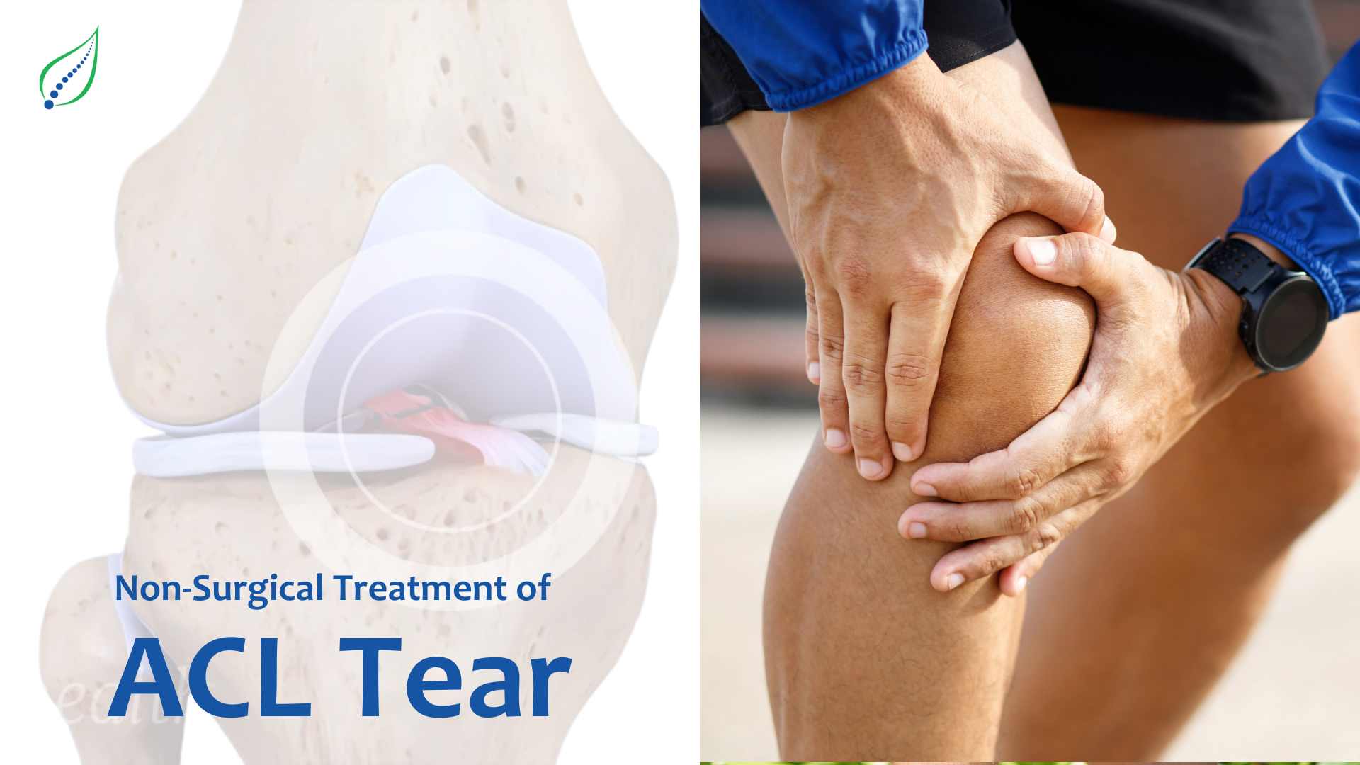 Non-Surgical Treatment of ACL Tear